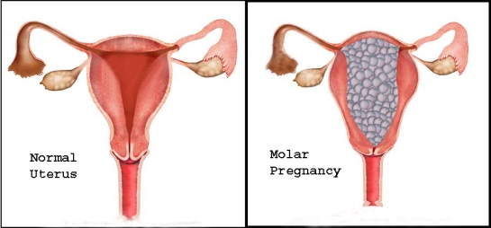 kehamilan-molar1